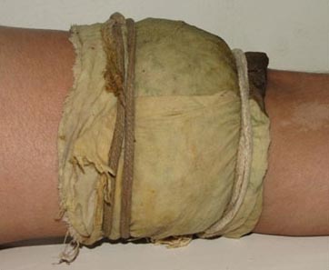 bandhan ayurvedic panchakarma treatment in pune 